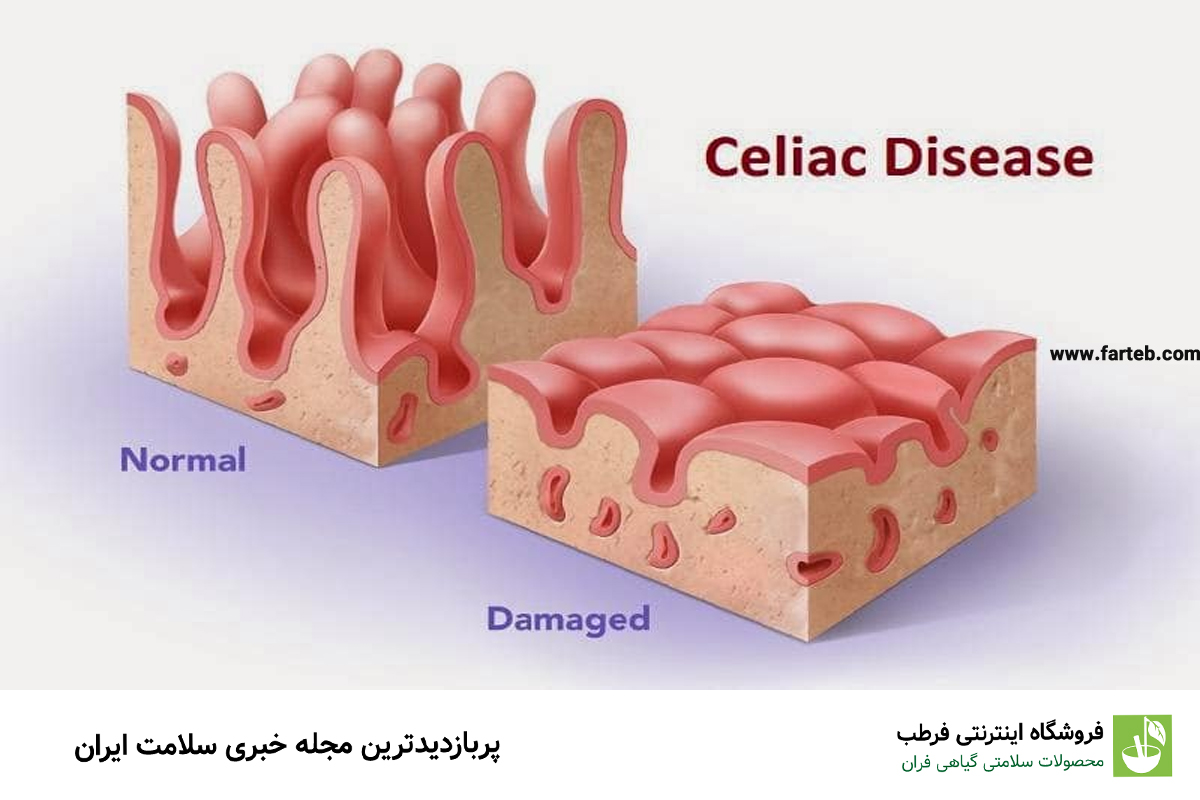 همه چیز دباره بیماری سلیاک